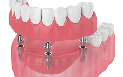 an image of dental implant-retained dentures