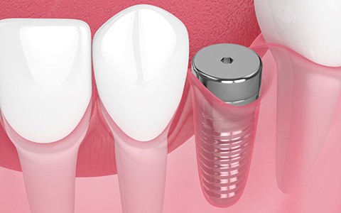 dentist showing a patient a model of a dental implant