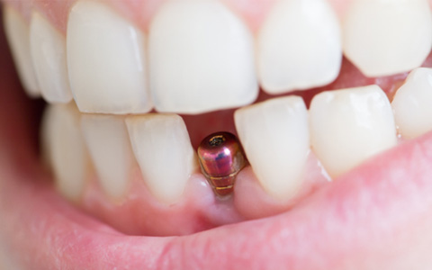 Up close view of a dental implant on the lower arch