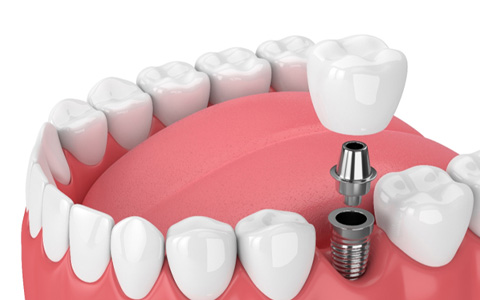 A digital image of dental implant