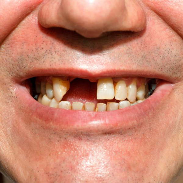 Close up of patient’s missing tooth.
